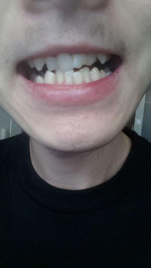 成人换门牙视频过程,从拔牙到新牙的蜕变之旅